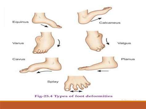 What is CTEV (Clubfoot) 